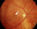 Altersbedingte trockene Maculadegeneration